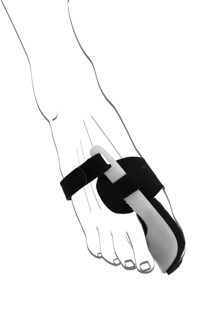 Abbildung einer Fußskizze mit angelegter Valex N Nachbandage von Berkemann. Die schwarz-weiße Bandage wird über dem Mittelfuß mit einem Klettverschluss fixiert und korrigiert sanft die Stellung der Großzehe. Sie ist individuell nach Beschwerdegrad einstellbar und unterstützt eine natürliche Fußausrichtung.